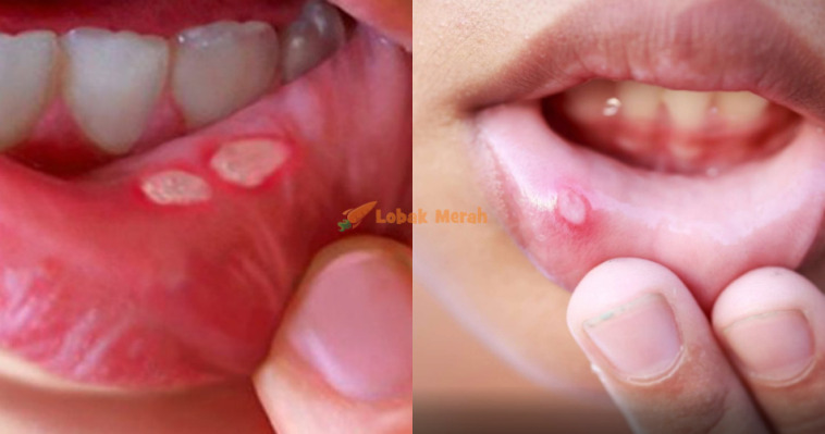 1ulcer
