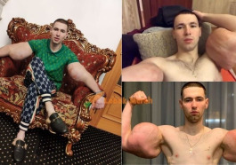 Demi biceps berotot Popeye Rusia Ini Sanggup Suntik Lengan Sendiri Dengan Petroleum Jelly