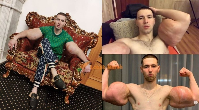 Demi biceps berotot Popeye Rusia Ini Sanggup Suntik Lengan Sendiri Dengan Petroleum Jelly