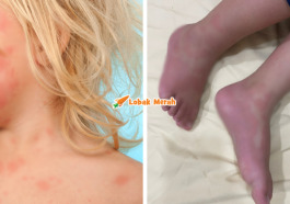 urticaria