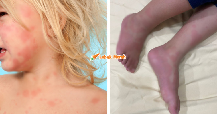 urticaria