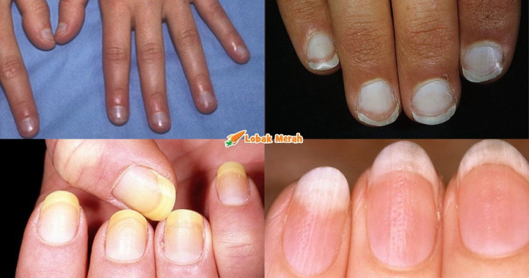 f1 nail health