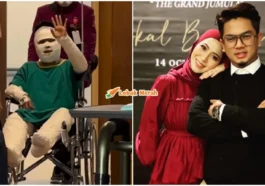 suami syura berbalut akibat melecur
