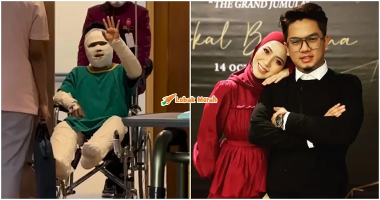 suami syura berbalut akibat melecur