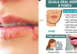 Oral Herpes